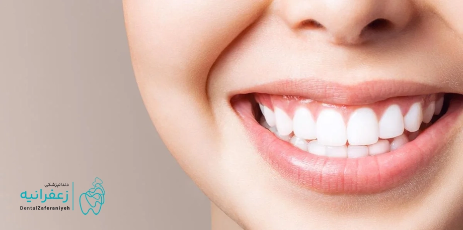بلیچینگ دندان در خانه + روش‌ها و نکات کاربردی