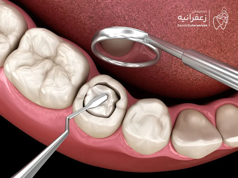 کامپوزیت دندان
