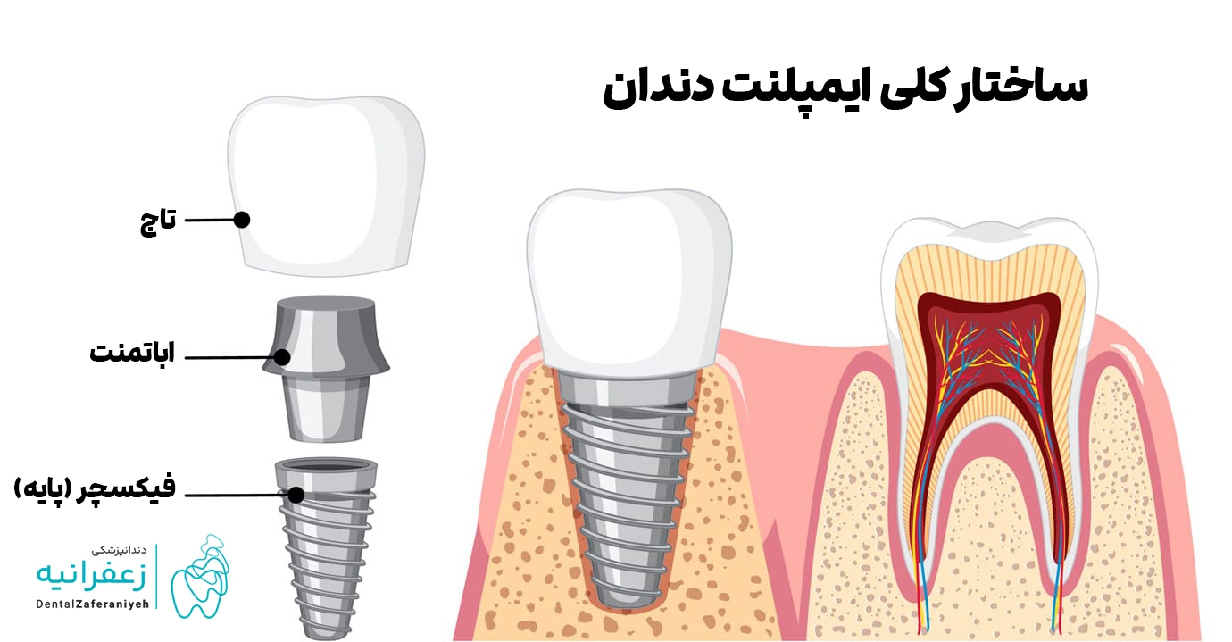 دوره نقاهت ایمپلنت دندان