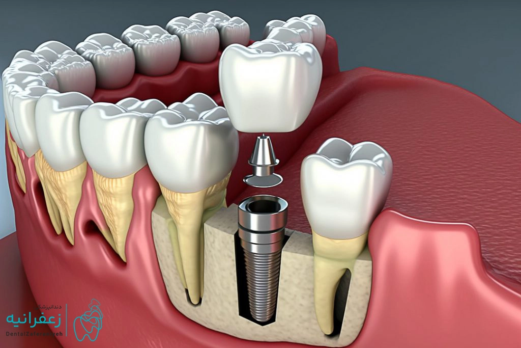 ایمپلنت دندان چیست؟ هر آن چه که باید درباره ایمپلنت دندان بدانید!