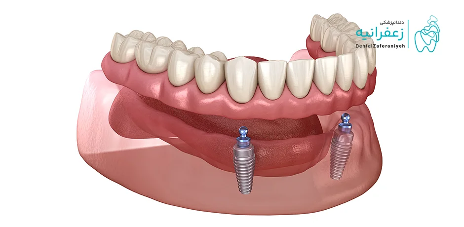 ایمپلنت کامل فک بالا و پایین