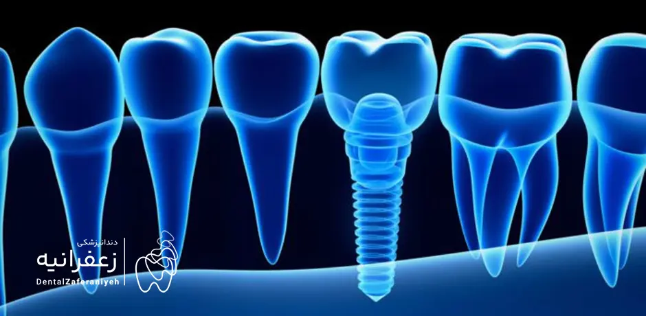 ایمپلنت دیجیتال با تصویر برداری سه بعدی